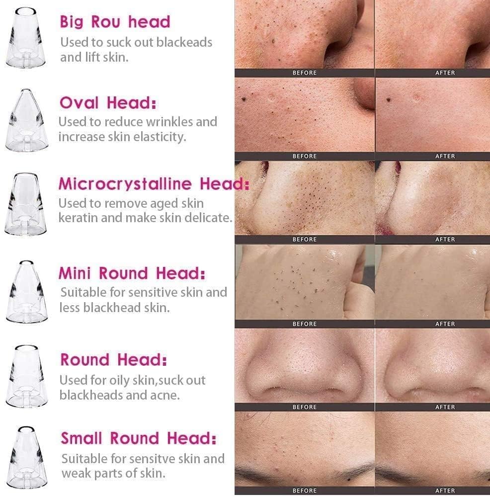 Blackhead & Whitehead Extractor