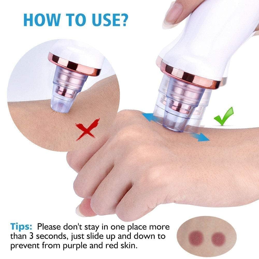 Blackhead & Whitehead Extractor